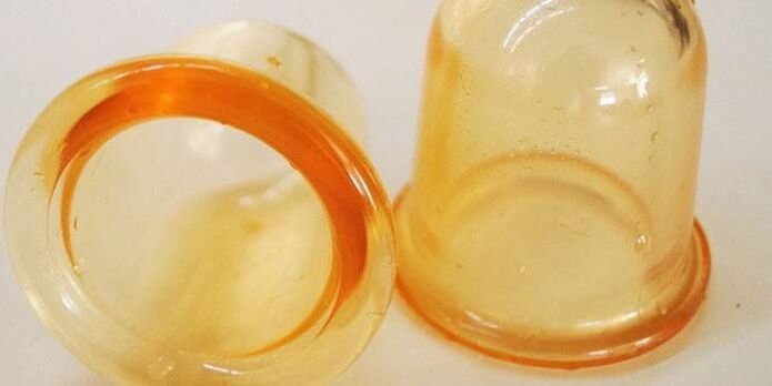 kubki do leczenia zapalenia prostaty