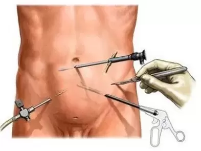 chirurgiczne leczenie przewlekłego zapalenia gruczołu krokowego