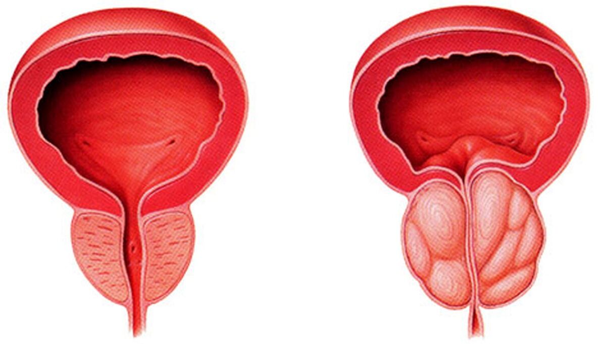 zdrowa i zaogniona prostata z zapaleniem gruczołu krokowego